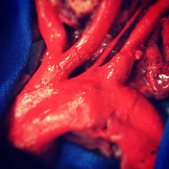 Dissection of Aortic arch