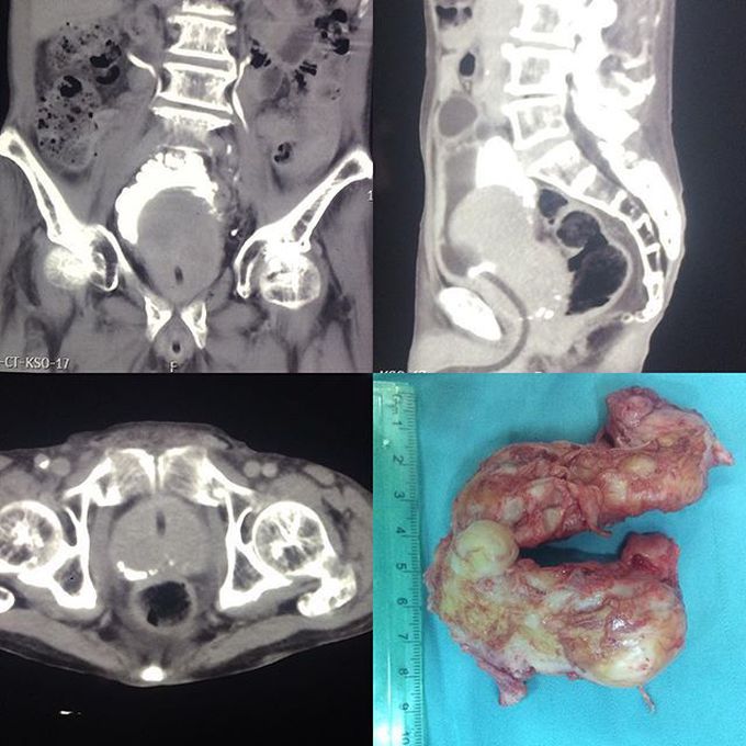 82 y.o male with urinary obstruction symptoms for more than 15 years