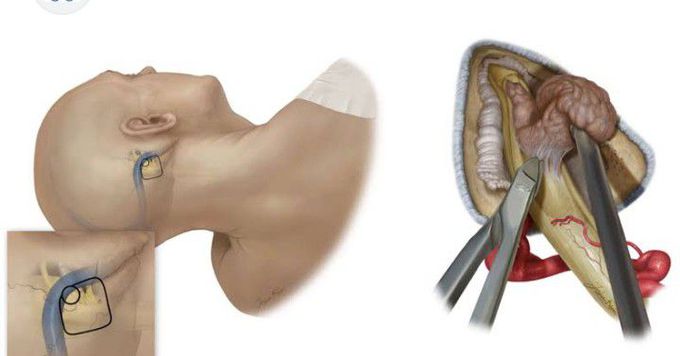 Treatment for Ear tumor