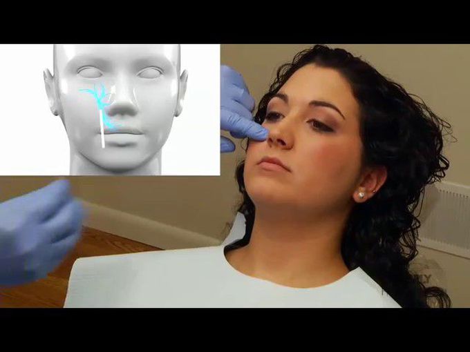 Maxillary Anesthesia Injection Techniques