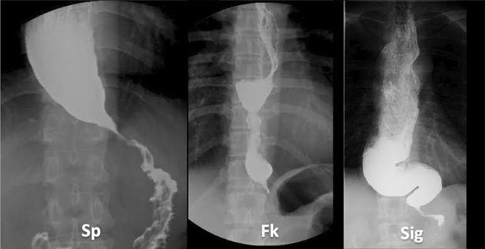 What are complications of achalasia treatmet?