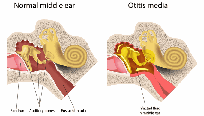 What are the symptoms of an ear infection?