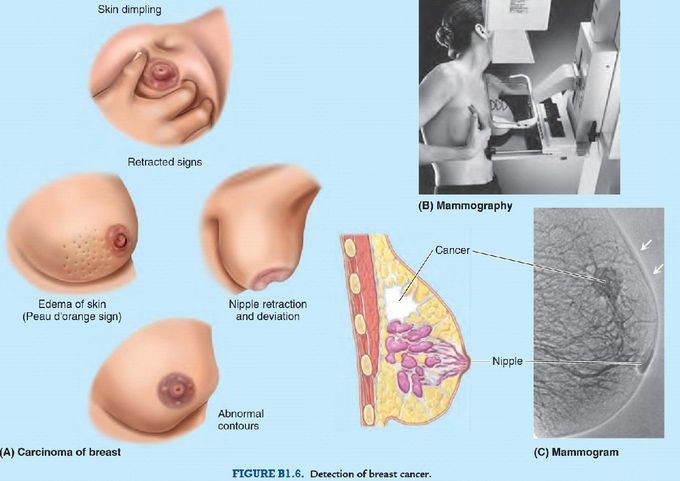 Carcinoma Of Breast