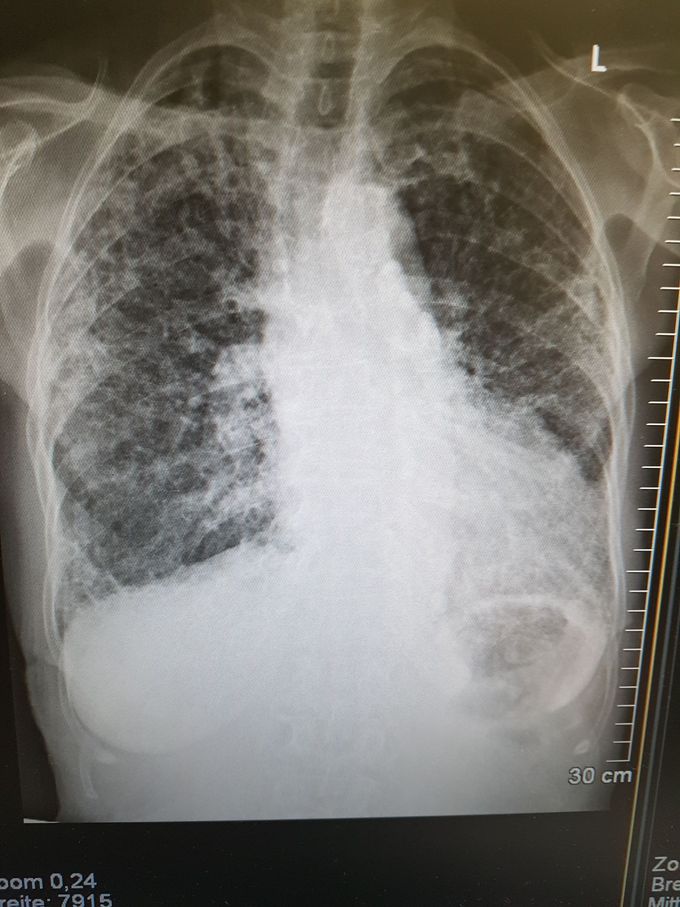 X-ray of 86 year old woman