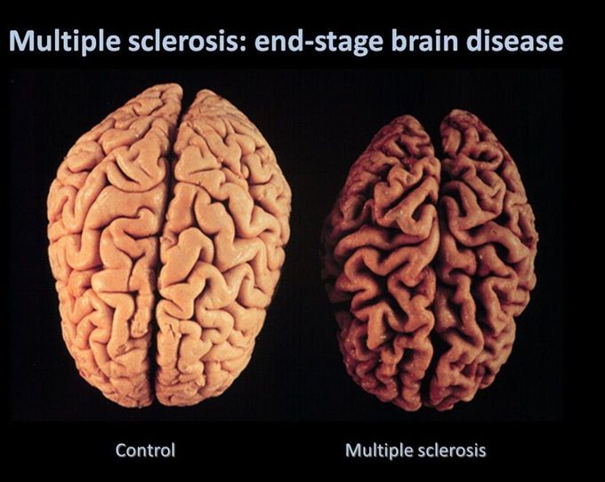 Multiple sclerosis