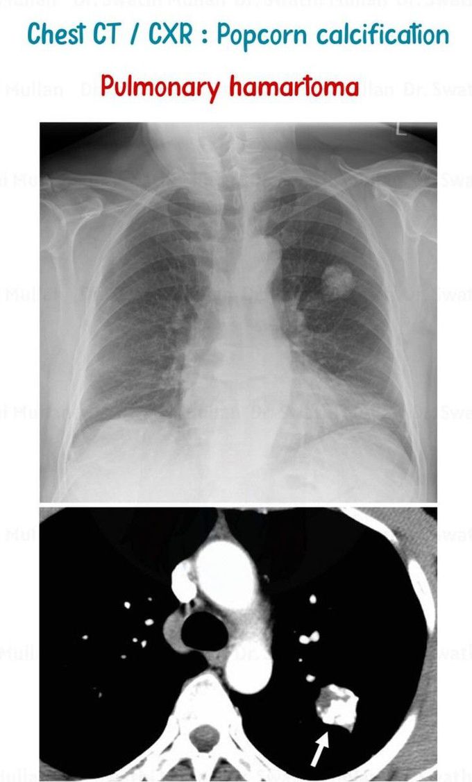 Pulmonary Hemartoma