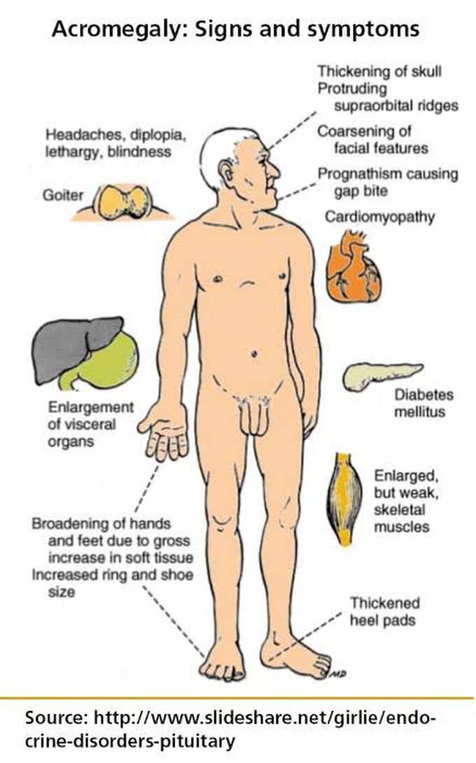 Acromegaly