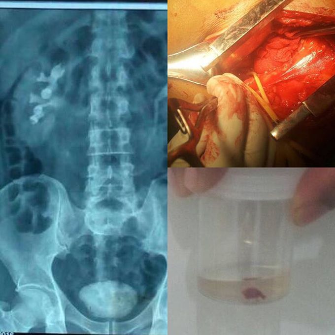 Ureteric stone removal through open ureterolithotomy 