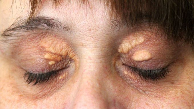 Removal Options for Xanthelasma