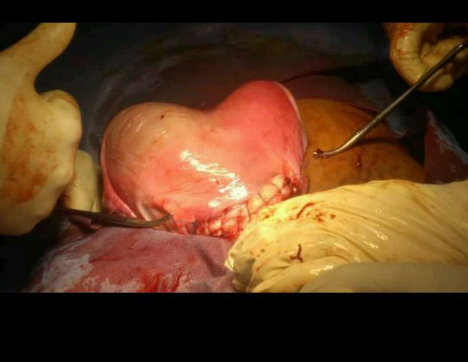 Bicornuate uterus