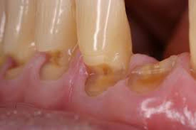 Symptons of dental abrasion