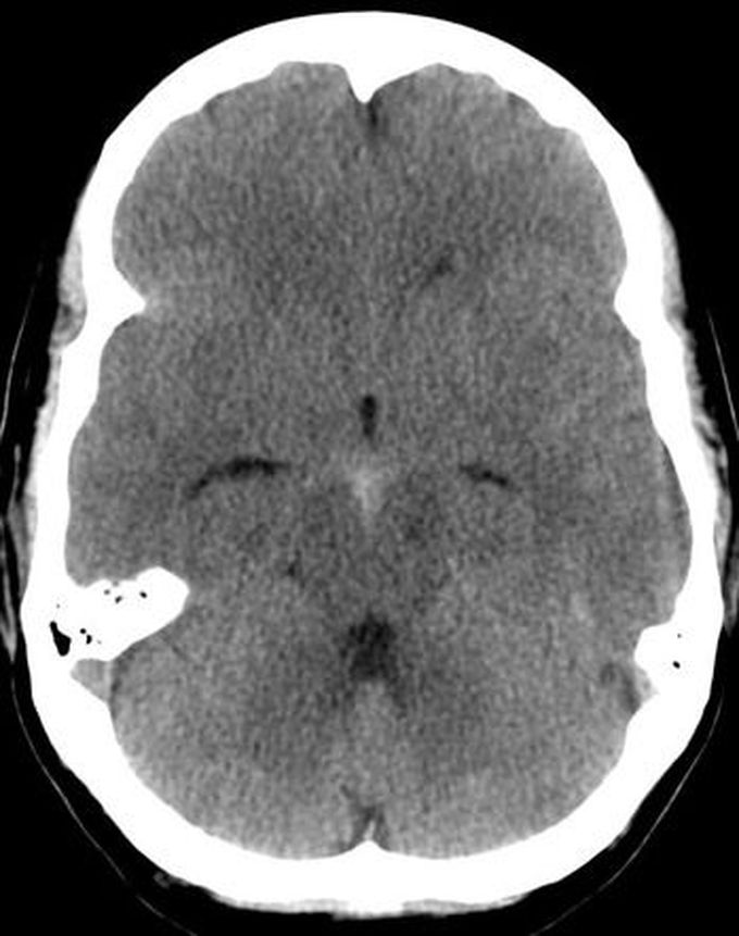 CT Findings in Subarachnoid Hemorrhage