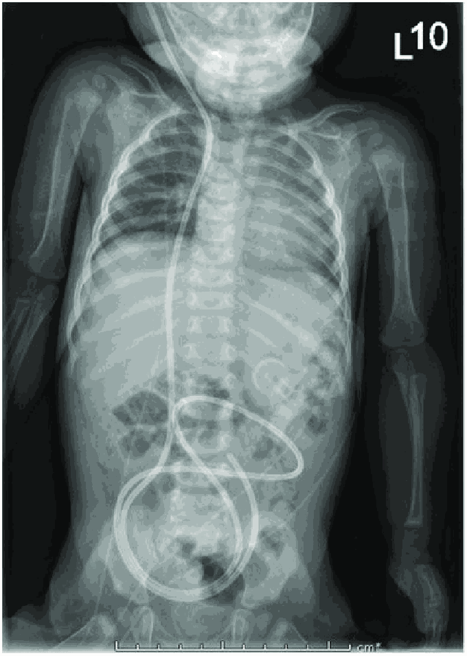 Ventriculoperitoneal Shunt Medizzy