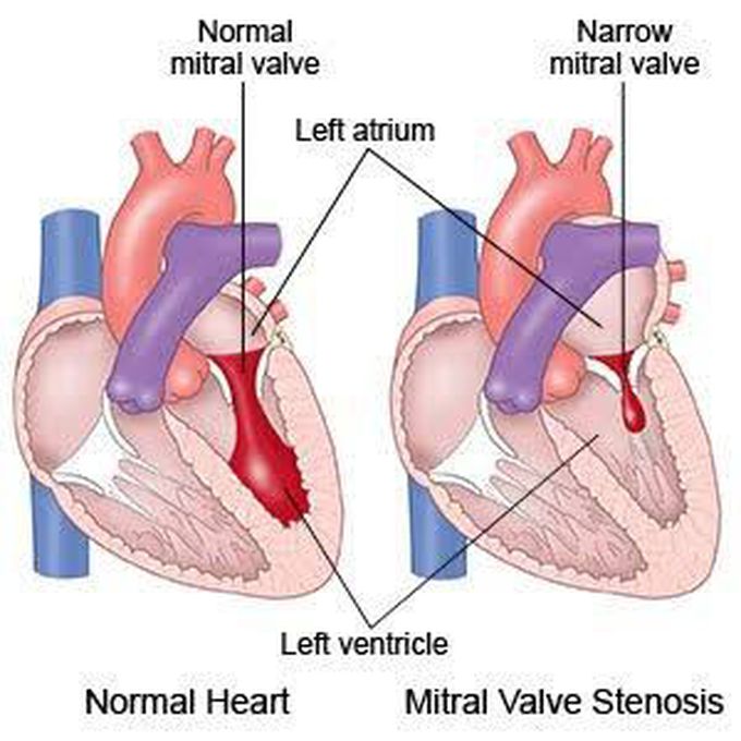 Mitral stenosis symptoms