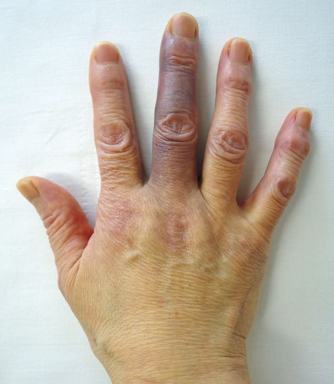 Achenbach’s Syndrome