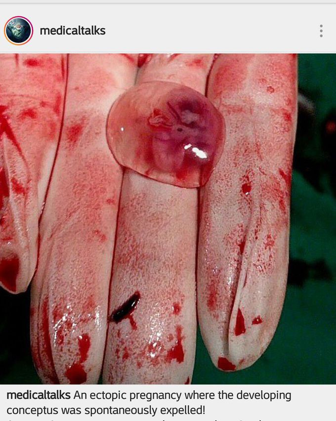 Ectopic pregnancy