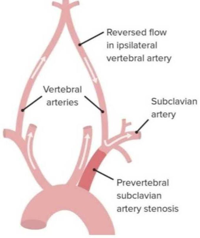 Subclavian Steal Syndrome