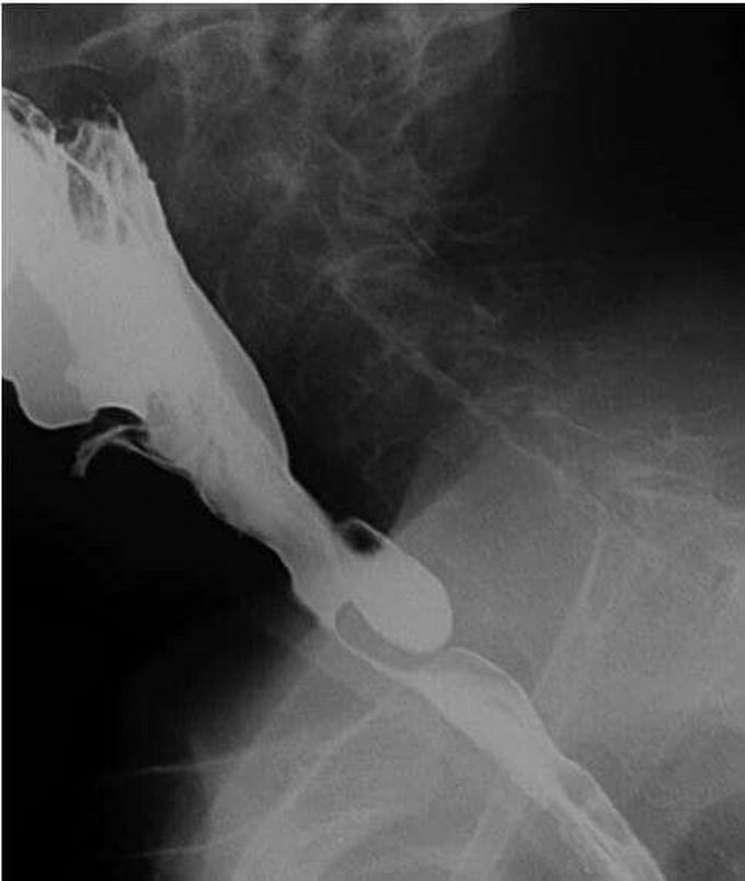 ZENKER'S DIVERTICULUM