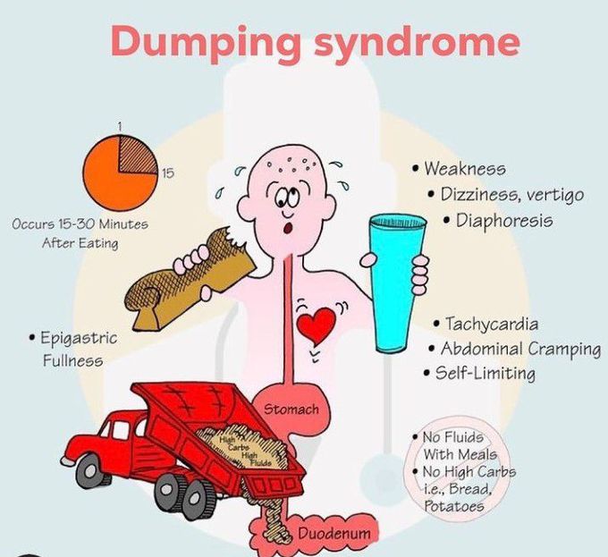 Dumping syndrome