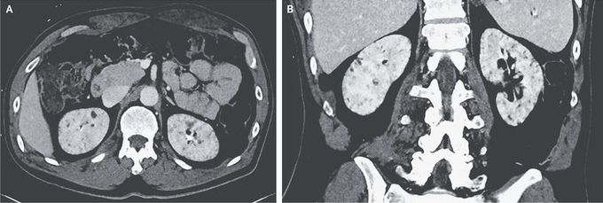 Lithium-Induced Nephropathy