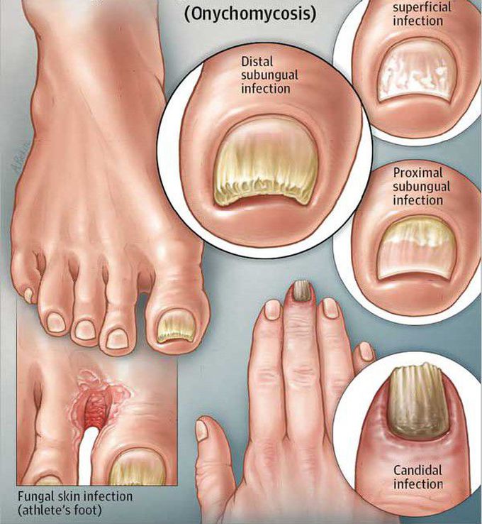 Symptoms of Onychomycosis