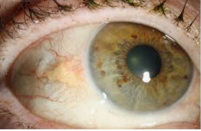 Eye Lesion