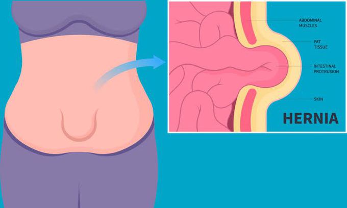 Umbilical Hernia