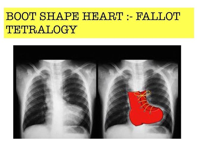 Boot Shaped Heart