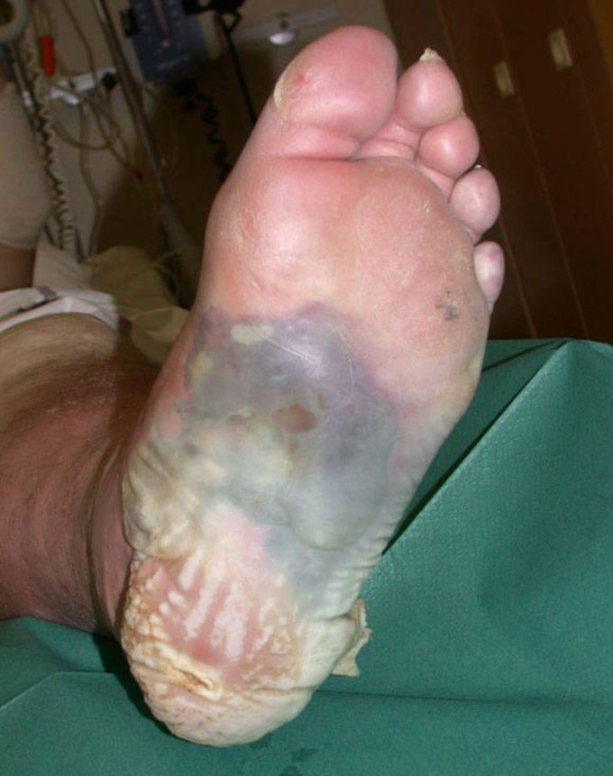 Osteomyelitis