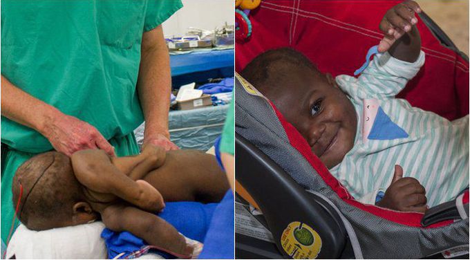 Baby Dominique, born with 4 legs and 2 spines, survives risky surgery