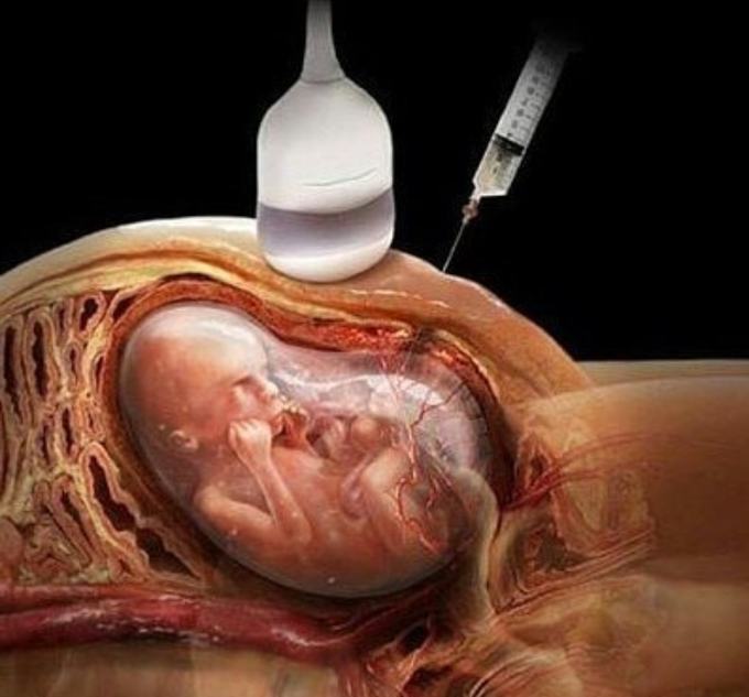 Don't do this as a doctor😡😡early detection of gender is a medical crime ;ultra sound and NIPT test can detect baby in early stages