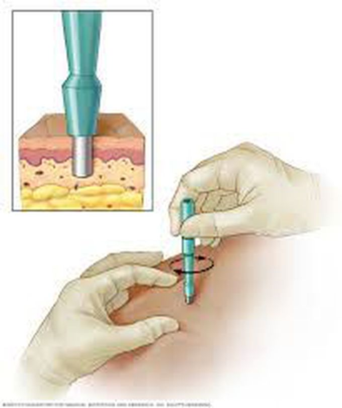 Biopsy