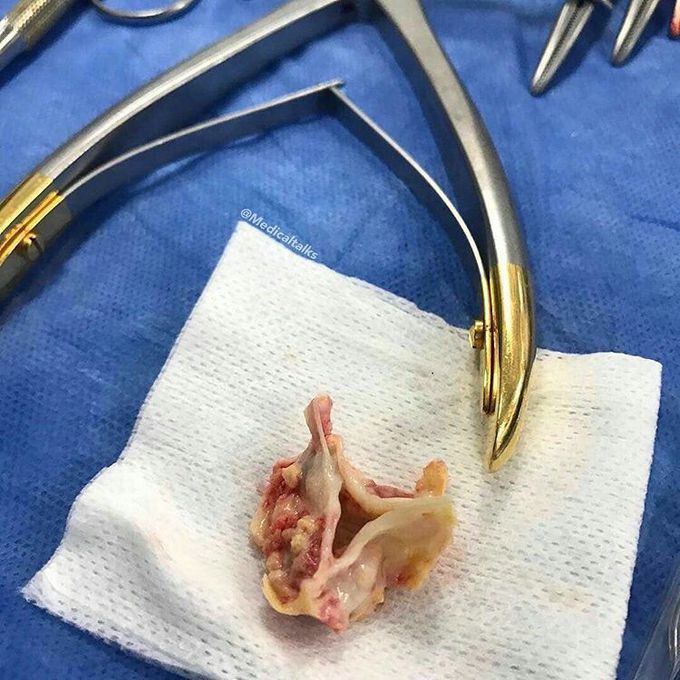 Aortic valve calcification