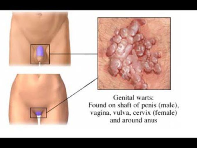 Genital Warts