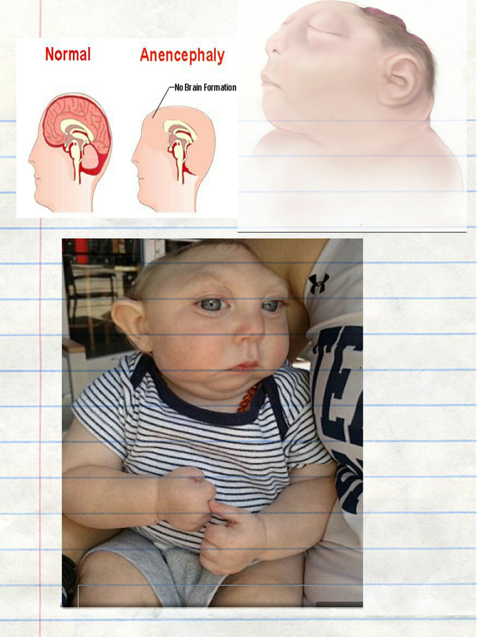 Anencephaly