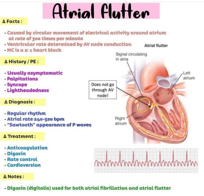 Atrial Flutter