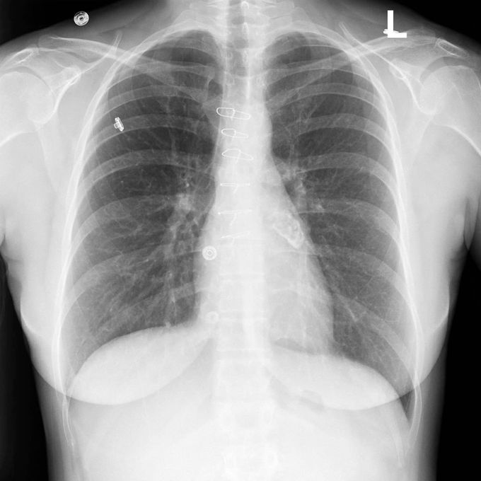 Post-Kawasaki disease findings