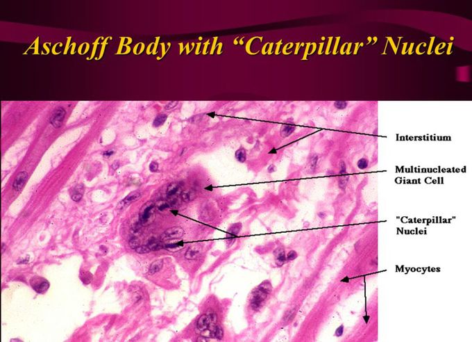 Rheumatic Heart Fever