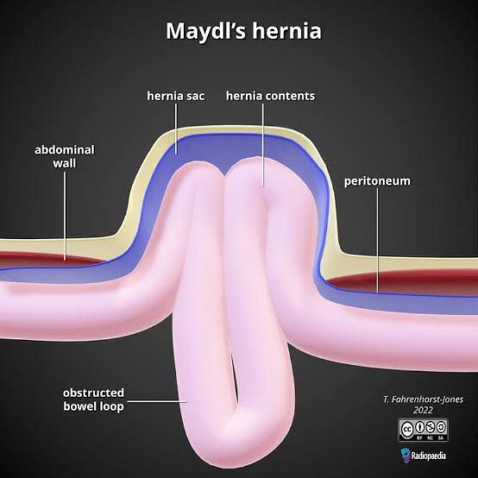 Maydl hernia