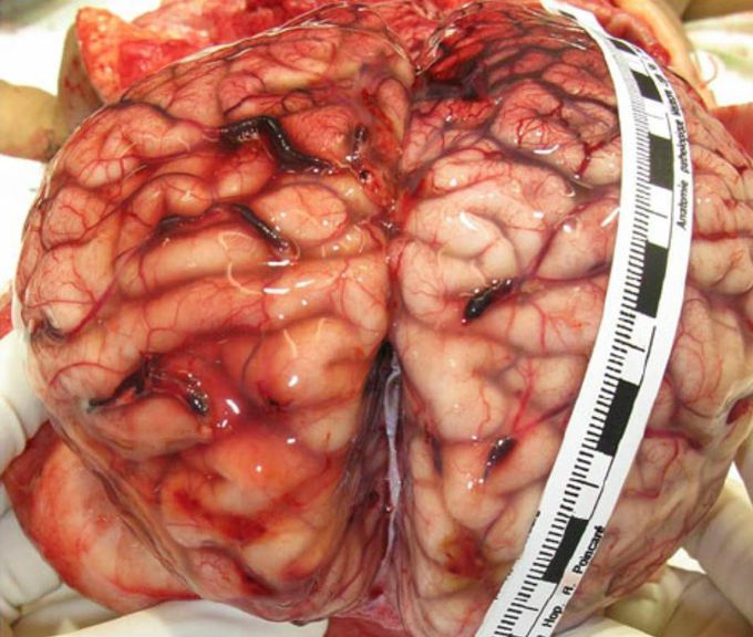 Multiple bridging vein thrombosis in a case of confessed abusive head trauma with subdural diffuse haematoma