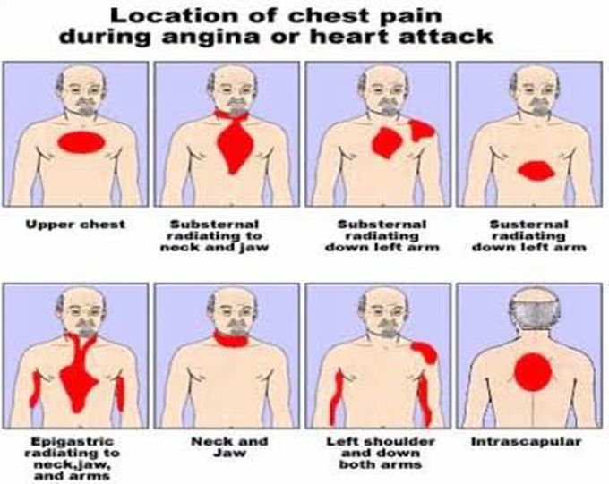 Location of chest pain during angina or heart attack
