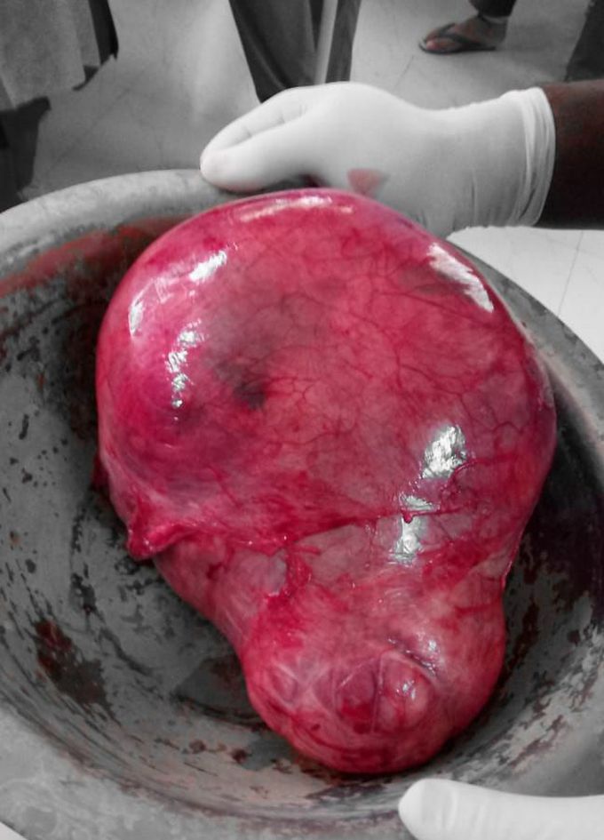 Leiomyoma