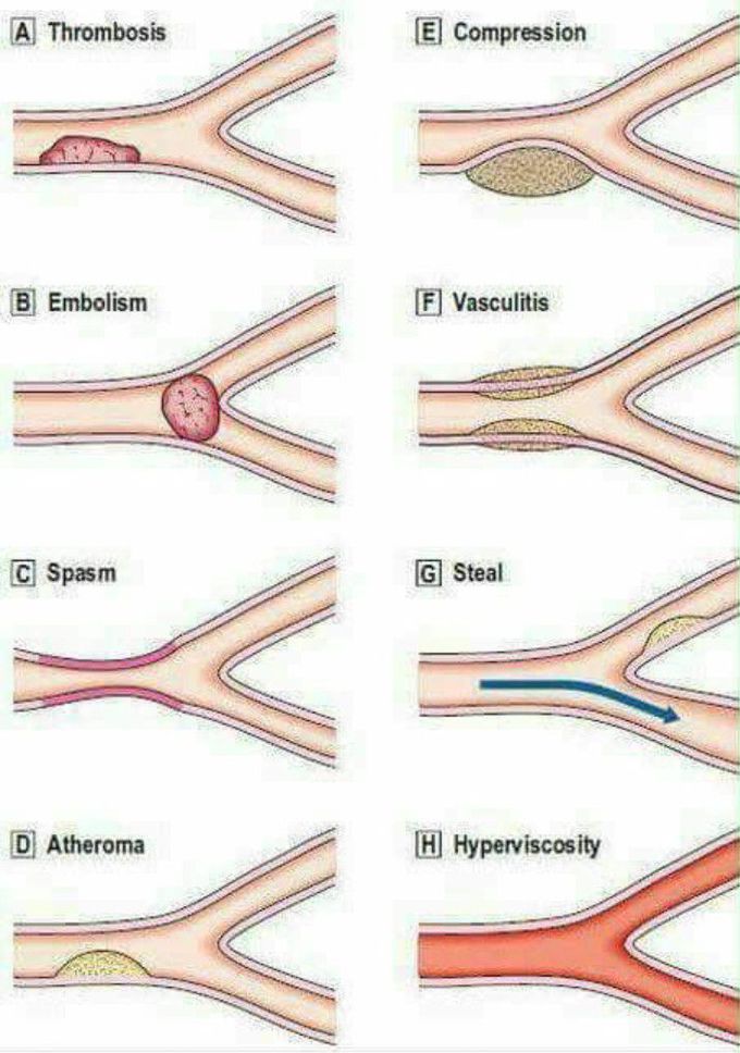 TYPES OF BLOOD CLOT