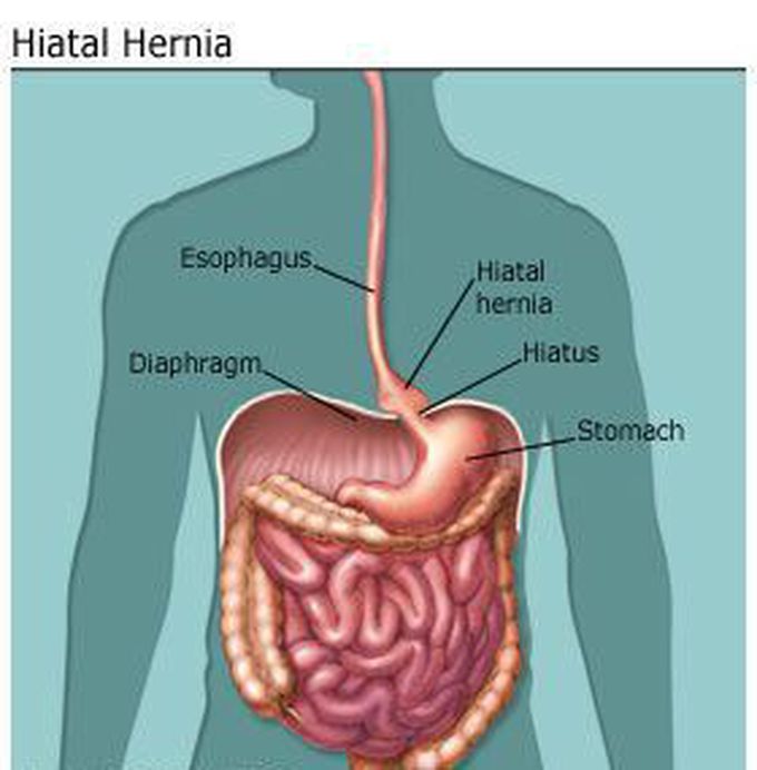 Hiatus hernia