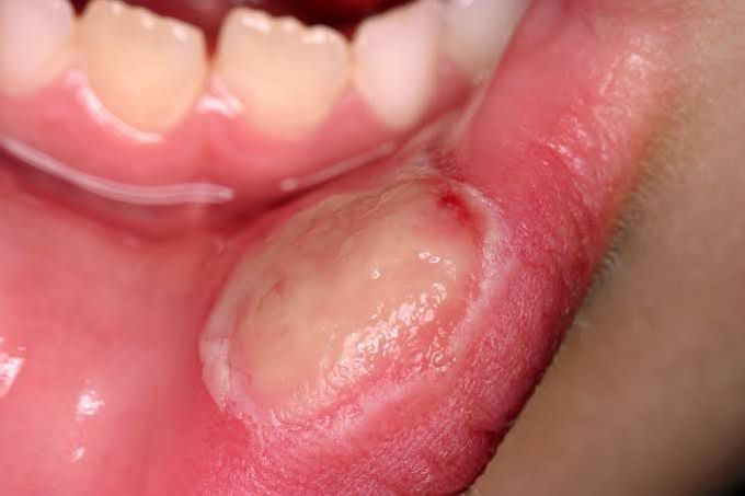 Symptoms of mouth ulcers