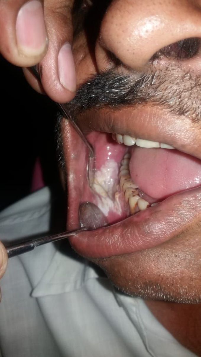vericuos carsinoma