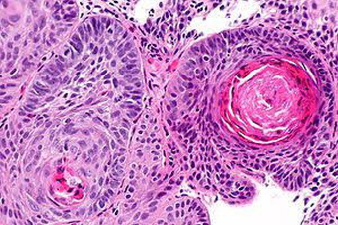 Squamous Cell Carcinoma of Esophagus