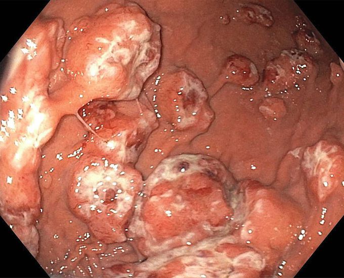 Gastrointestinal Bleeding from Metastatic Melanoma