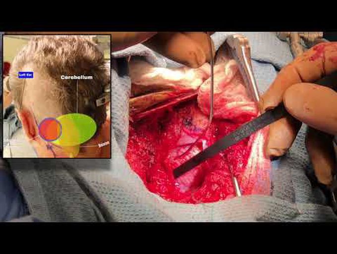 Microsurgical resection of a medullary cavernous malformation through a far lateral approach