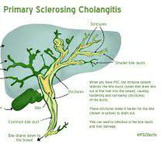 Sclerosing cholangitis treatment